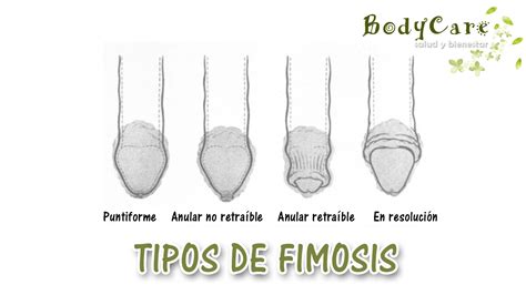 fimosis imagenes|Image: Fimosis